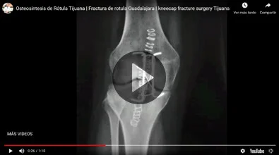 Prótesis de cadera - Traumatólogo y Ortopedista